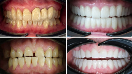 Full Smile Makeover Including 20 Zirconia Crowns: 7-Night Half Board Stay & Airport Transfers - Healing Journey Medical, Antalya Turkey! | Wowcher